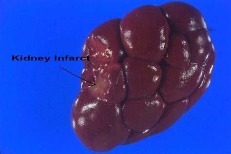 lesions on kidney